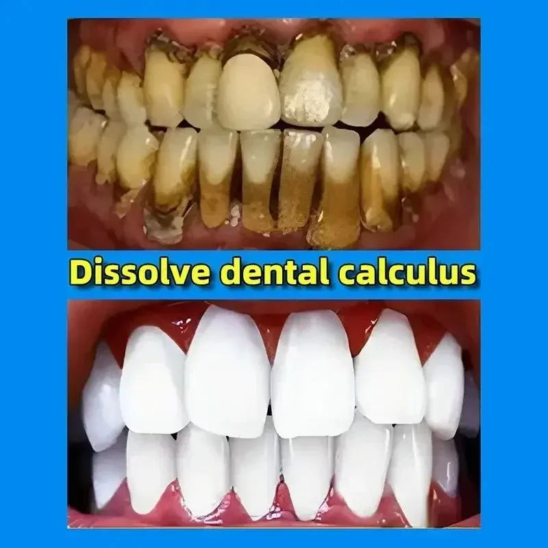 Dental Calculus Remover Whitening Bad Breath Teeth Toothpaste Brightening Preventing Periodontitis