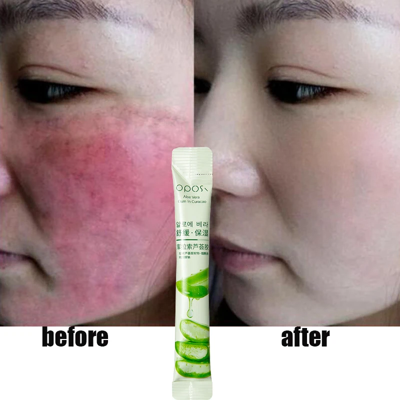 Instant Facial Redness Repair Serum Improve Sensitive Skin Anti-Allergy Products Redness Rosacea Itching Soothing Korean Care