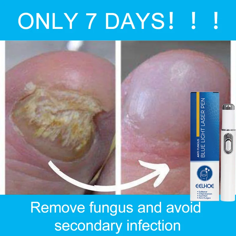 Nail Fungal Treatment Feet Care Essence Repair Nail Fungus Removal Serum Gel Anti Infection Paronychia Onychomycosis