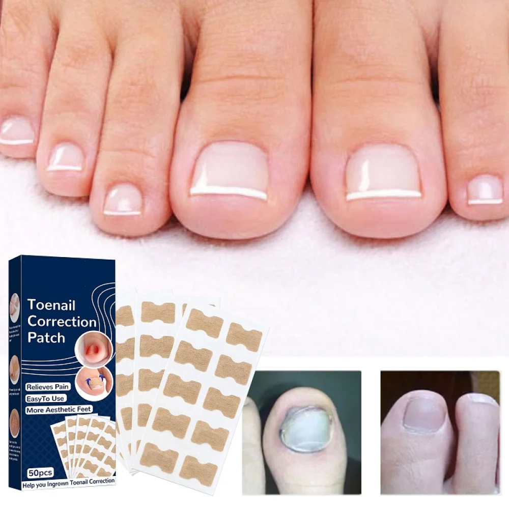 50pcs Nail Correction Stickers Ingrown Toenail Corrector Painless Pedicure Waterproof Paronychia Treatment Pedicure Tools