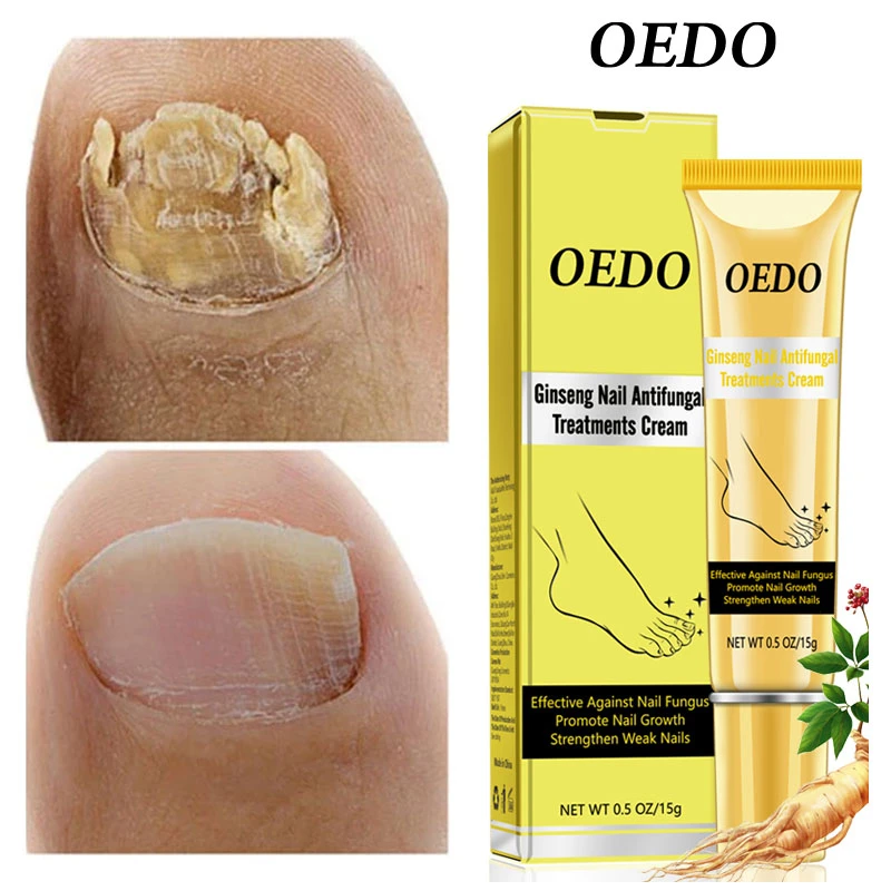 Oedo Ginseng Nail Fungus Repair Cream Hand Foot Antifungal Treatment