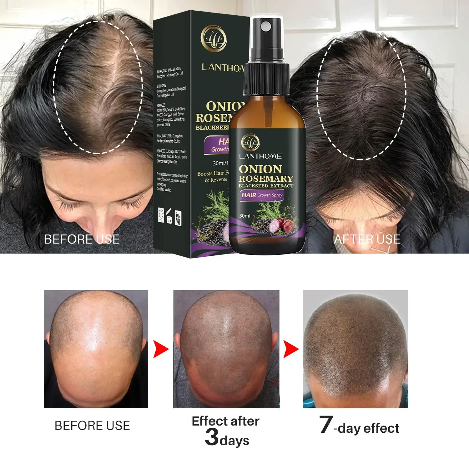 

Rosemary And Onion And Black Rice Extract Hair Growth Spray Hair Growth Oil For Hair Repair Treatment Hair Growth Products