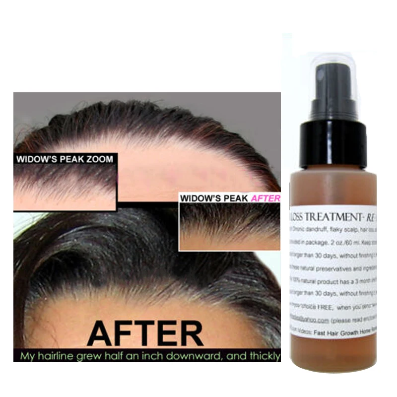 

ORGANIC HAIR REGROWTH TREATMENT MEN & WOMEN HAIR LOSS TREATMENT NATURAL & FAST SPRAY 2 oz