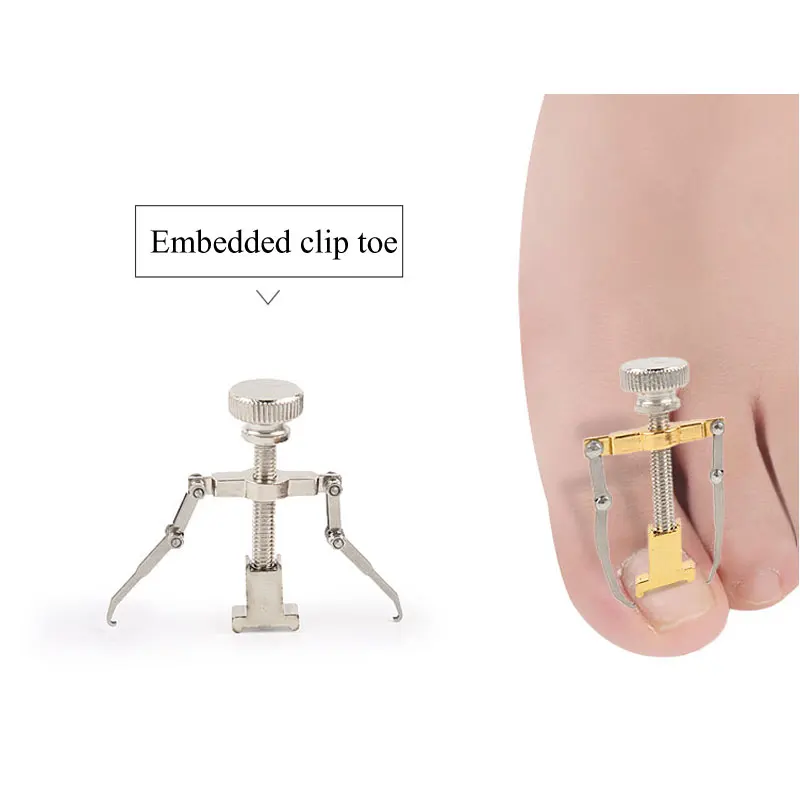 Correction of Paronychia with Toe Nail Correction Bracket for Treatment of Toe and Toe Care with Toe Fixator 5