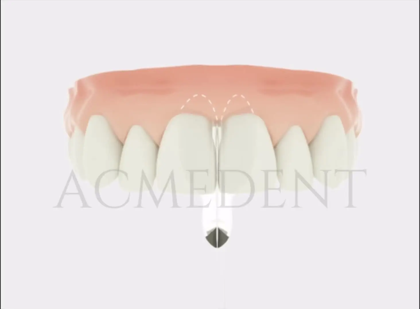 Kit De Matrices Dentaires Transparentes Pour Diastèmes - Similaires BioClear - Neuf