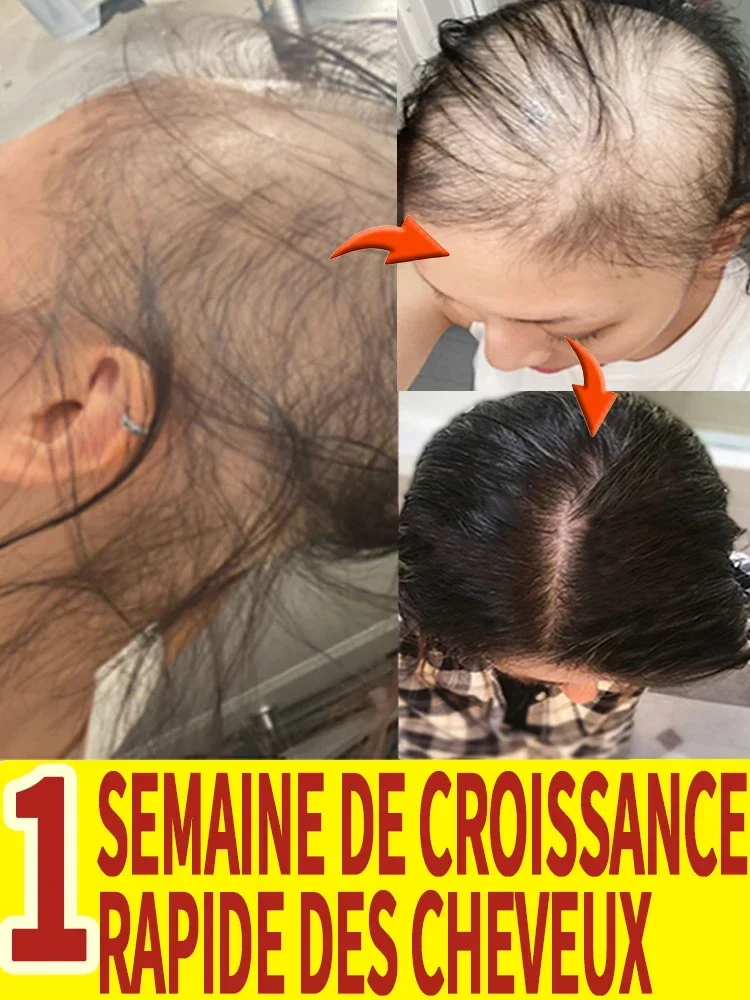Anti Hair Loss Spray 10ml for Hair Growth