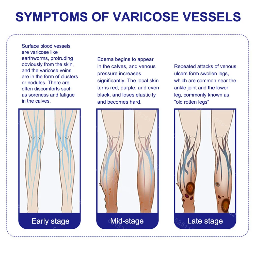 Varicose Vein Lampshade Therapy Effective Improved Blood Circulation Relief of Dilated Vasculitis In The Legs Phlebitis