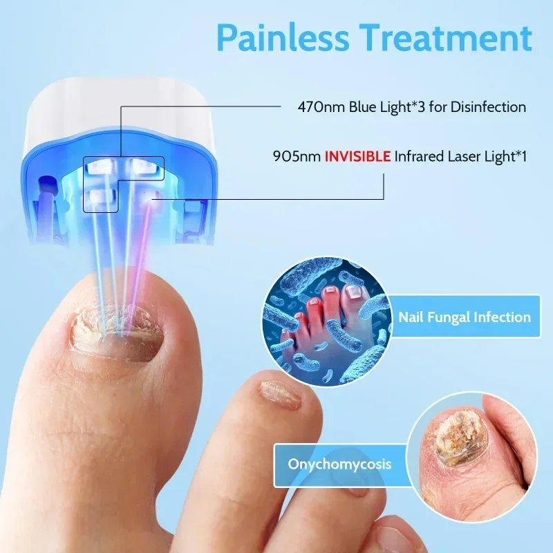 Effective Remover Fungus Machine Repair Nail Laser Fungus Device Damage Rechargeable Cleaning Nail Phototherapy Auxiliary Tools