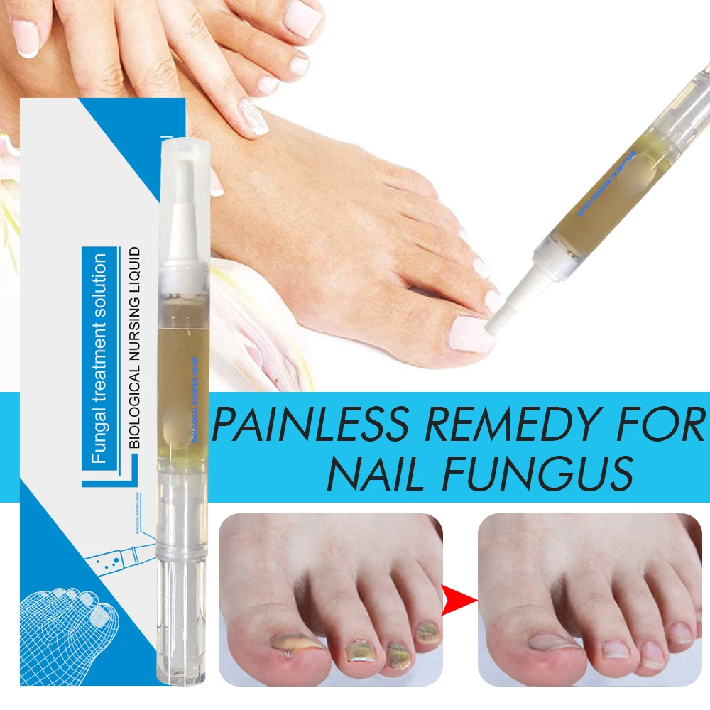 

Powerful Nail Treatments Pen Onychomycosis Paronychia Anti Fungal Nail Treatments Serum Foot Toe Fungus Repair Supplies TSLM1
