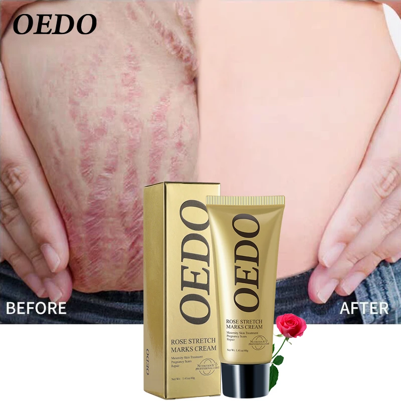 cara menggunakan oedo rose remove stretch mark cream