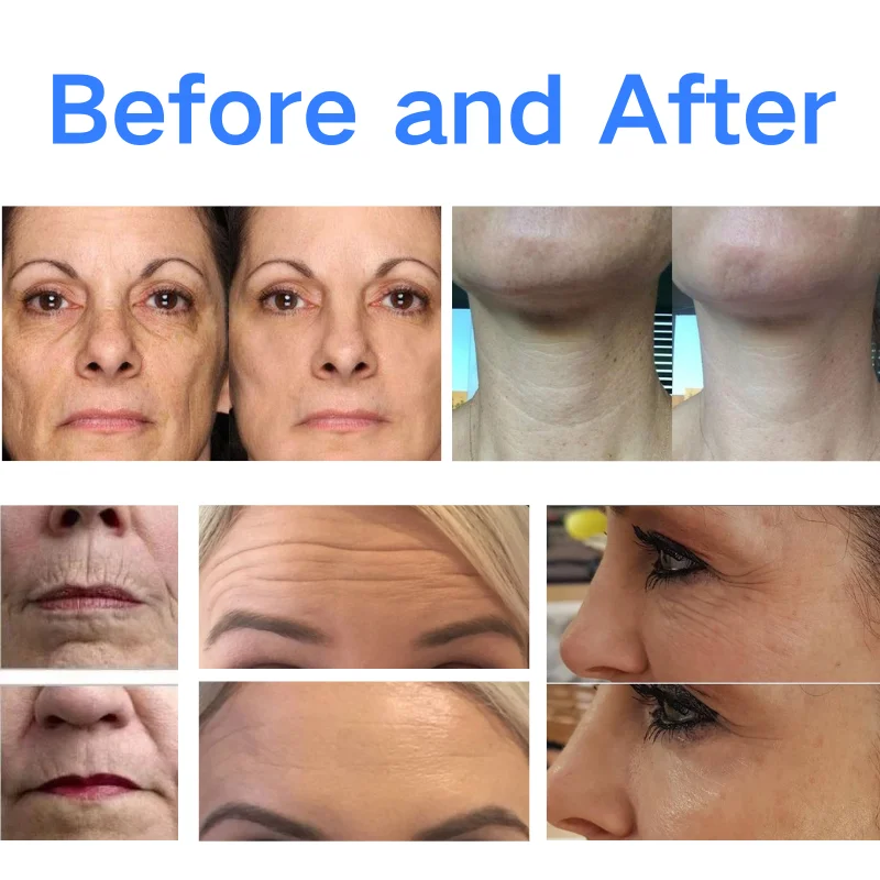  RF 얼굴 윤곽 교정, 피부 탄력 강화, 주름 제거, 바디 마사지 기기