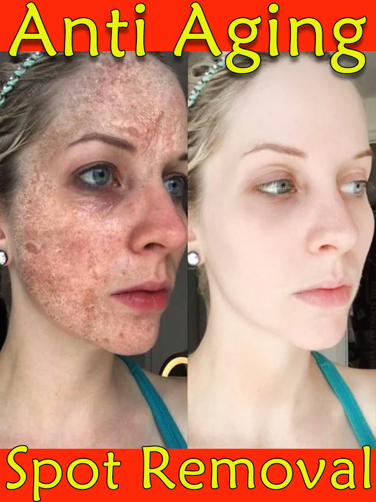 

Vitamin C Serum For Face Removal Freckles Melasma Dark Spot Age Spots Anti Aging Essence Brighten Skin Tone Skin Firming