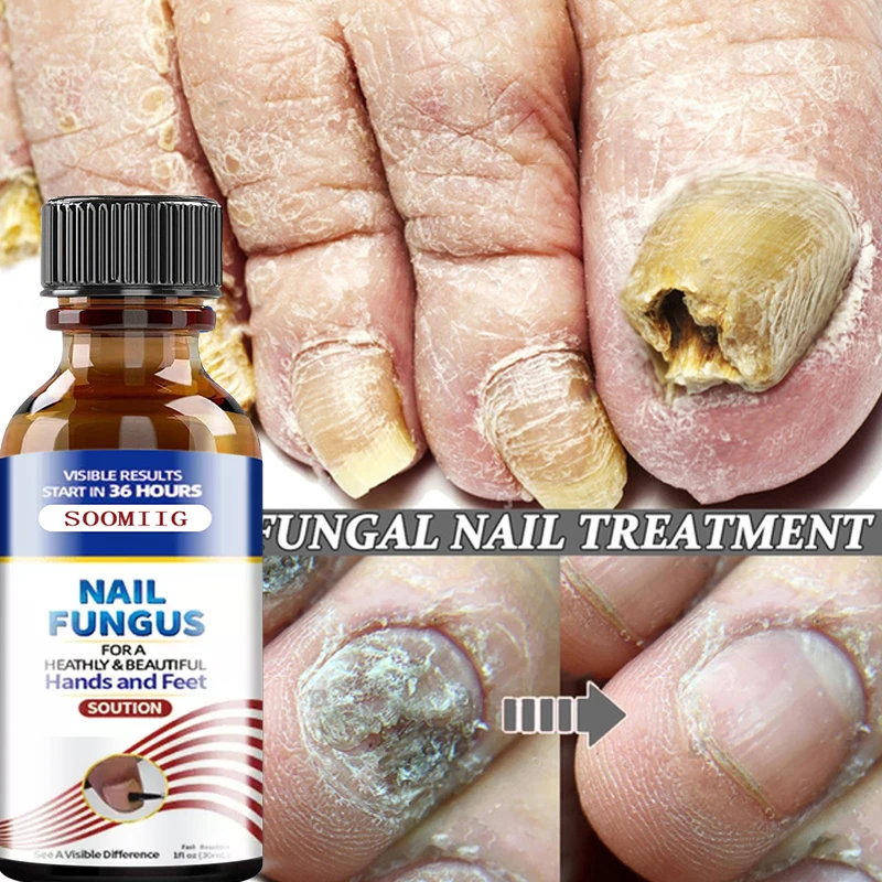 Sérum de traitement des champignons des ongles, soin des mains et des pieds,  traitement réparateur antifongique, anti-infection, tout neuf, 100% -  AliExpress