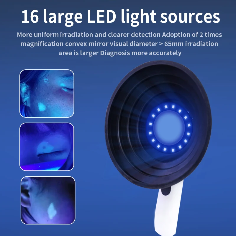 Cat Ringworm Detection Woods Lamp Skin Examination Skin Fungus Detector Vitiligo Pityriasis Versicolor Melasma Woods Light - Image 4