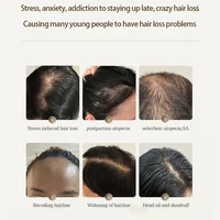SF52 traitements du cuir chevelu produit de croissance des cheveux prévenir le traitement de la calvitie Anti perte de cheveux sérum Spray cuir chevelu barbe beauté soins capillaires Pr 2