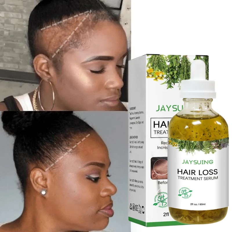 Miracle Rapid Hair Growth Serum Afro Crazy Regrowth Prevent Baldness