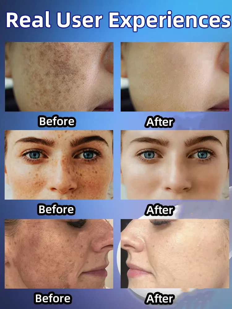 Facial Cream Whitening Freckles Removal Melasma Dark Spots Corrector Lighten Melanin Pigmentation Brighten Anti-Aging