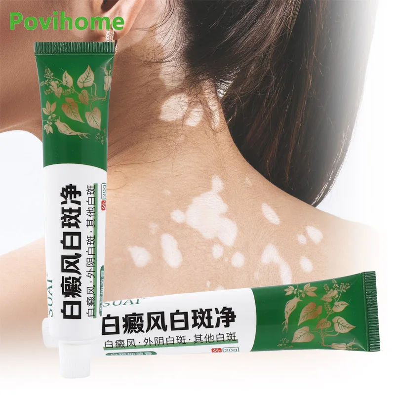 Мазь для Vitiligo антибактериальный крем с белыми пятнами удаления кожи леукоплакия