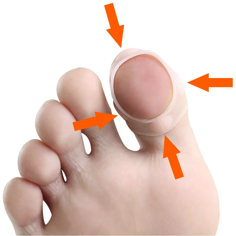 1Pair Gel Silicone Ingrown Toenail Correction Invisible Ingrown Toe Nail Straightening Clip Brace Treatment Foot Care Tools