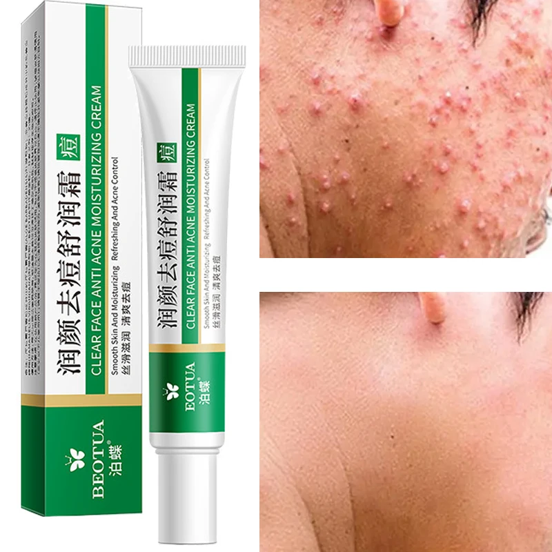 

Acne Removal Cream Aloe Vera Remove Dullness Pimple Scar Shrink Pore Oil Control Moisturizing Face Gel Acne Treatment Skin Care