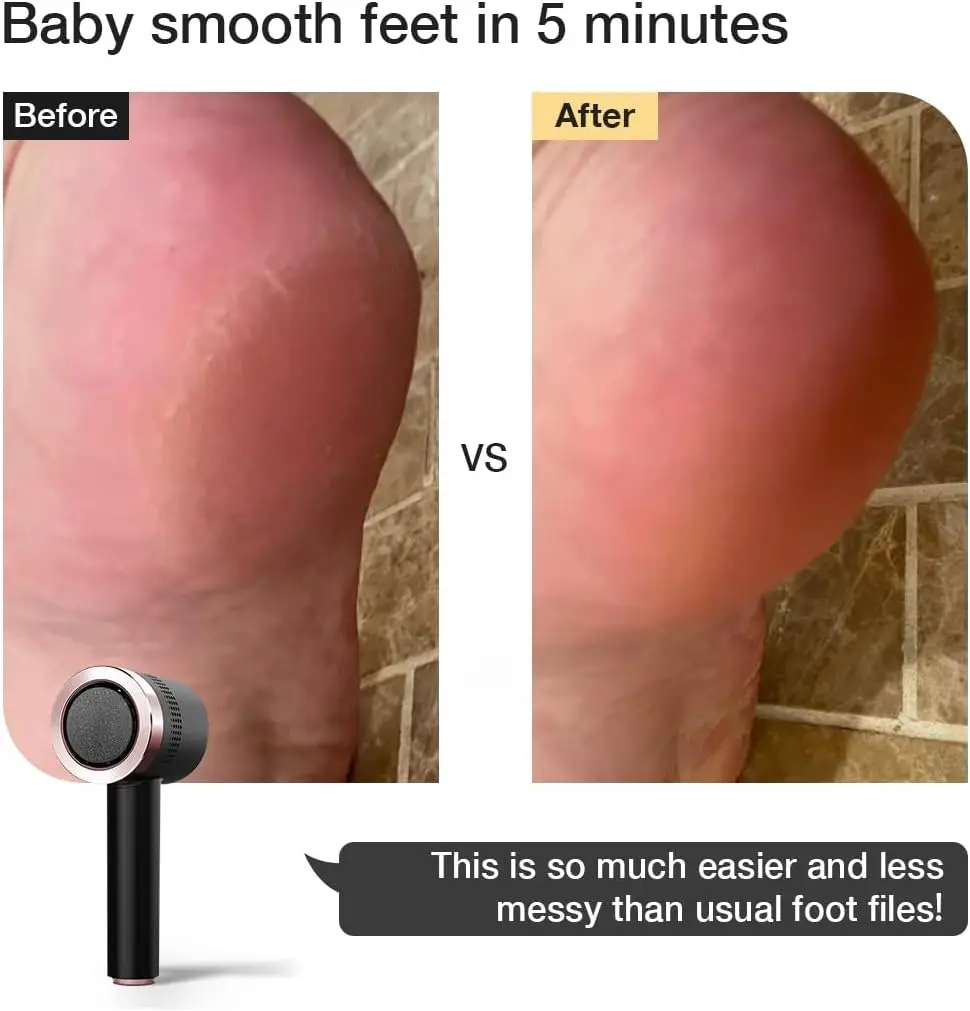 Electric Foot File Callus Remover, Rechargeable with Built-in Vacuum – Mess-Free, Painless, Powerful Pedicure Tool Kit for Smoot 2