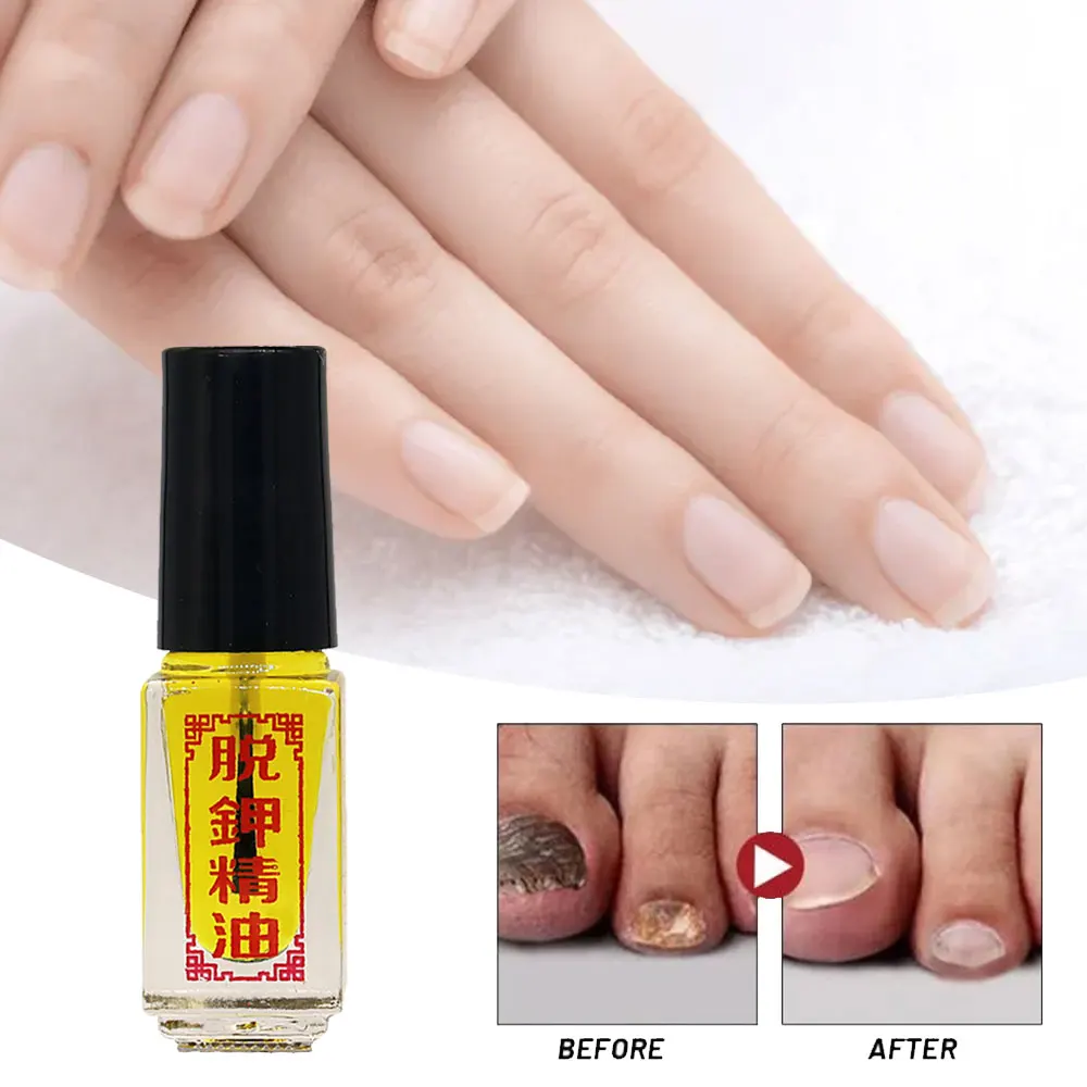 Nail Fungus Remover 3 Days Effect Nail Treatment Removal of onychomycosis Paronychia Anti oil Fungal Nail Infection Toe Fungus oil