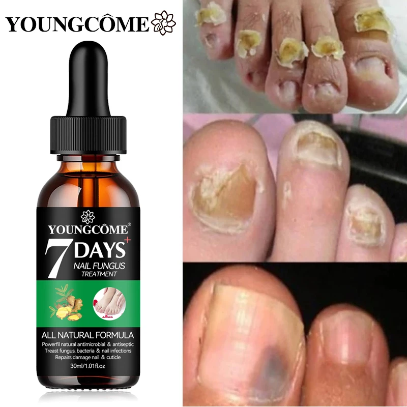 Nail Fungus Treatments Serum Foot Care Serum Toe Nails Fungal Removal