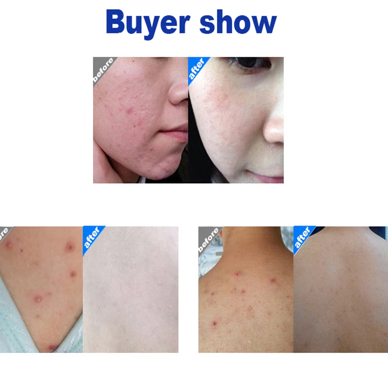 Original Shanghai Sulfur Soap For Bath Oil-Control Acne Eczema Anti Fungus Facial Whitening Eczema
