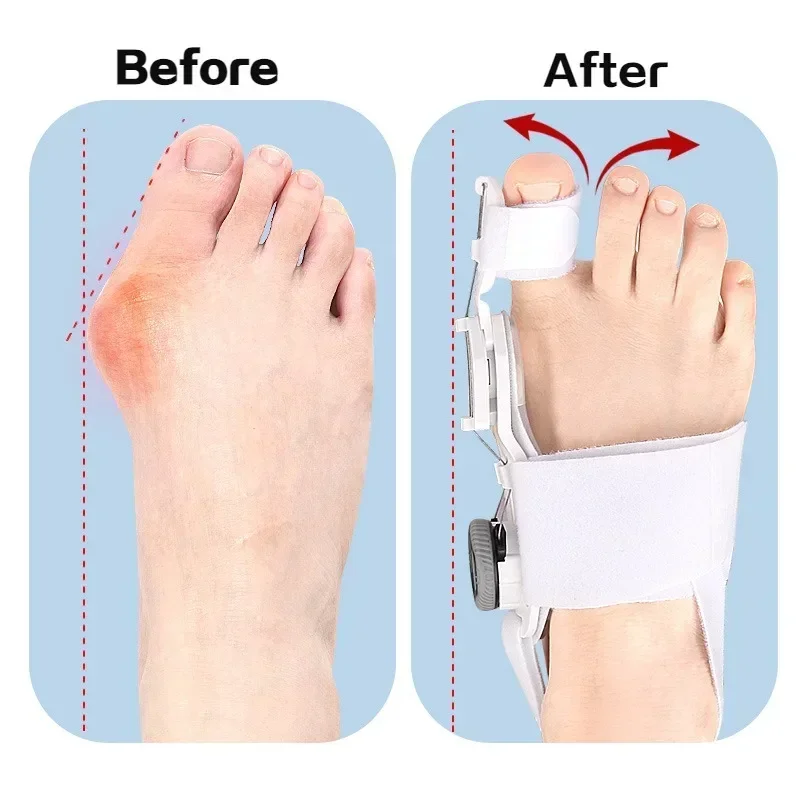 Bunion & Toe Corrector unisex foot hallux valgus braces rotatable toe separator straightener adjustable pedicure finger tool