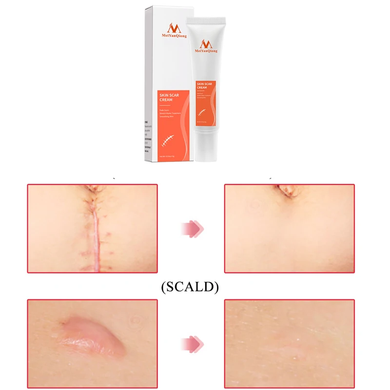 

Acne Fade Scars Cream Skin Repair Face Cream Acne Spots Acne Treatment Blackhead Whitening Cream Anti Scar Stretch Marks 15g