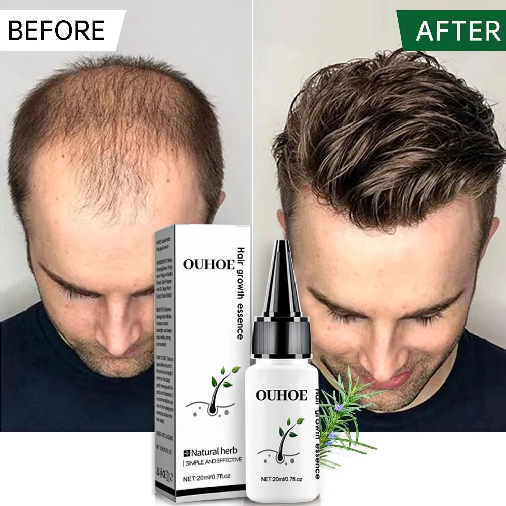 

Fast Hair Growth Essential Oil Anti Alopecia Prevent Hair Loss Serum Baldhead Scalp Treat Nourishing Hair Care Product Men Women