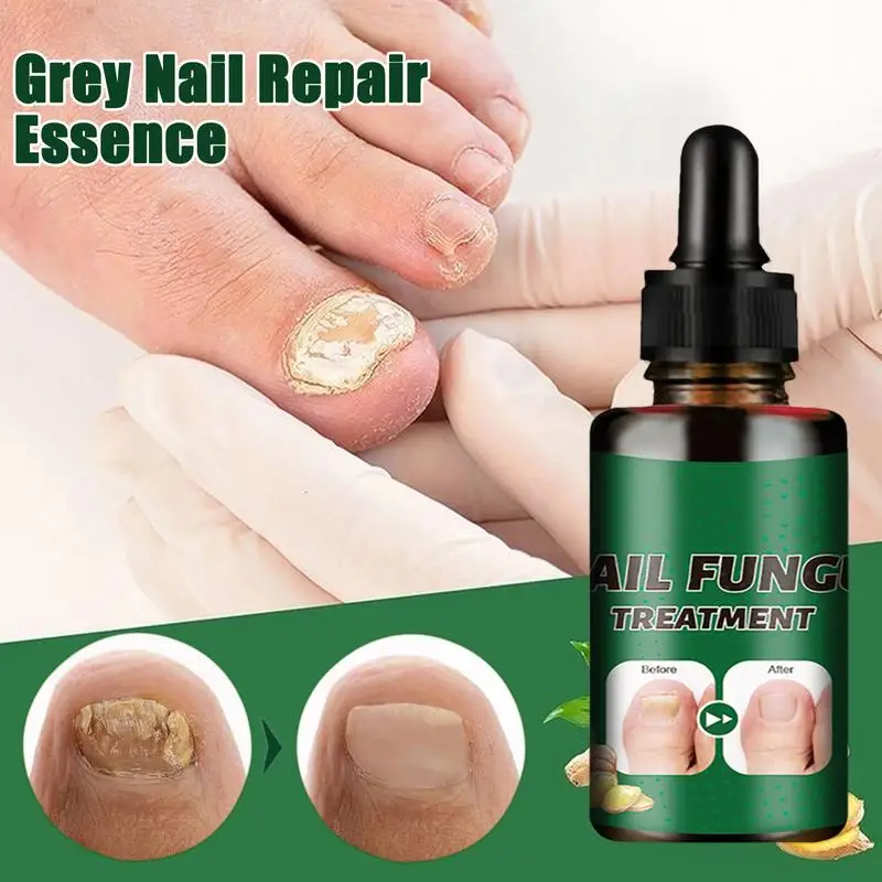 Nail Repair Solution Oenails Repair Onychomycosis Paronychia Anti Infec-tion Toe Nail New Fun-gus Nails Care Tool For Fingernail 1000pcs household 84 instant dis infec tant effervescent tablets hospital school pet dis infec tion tablets