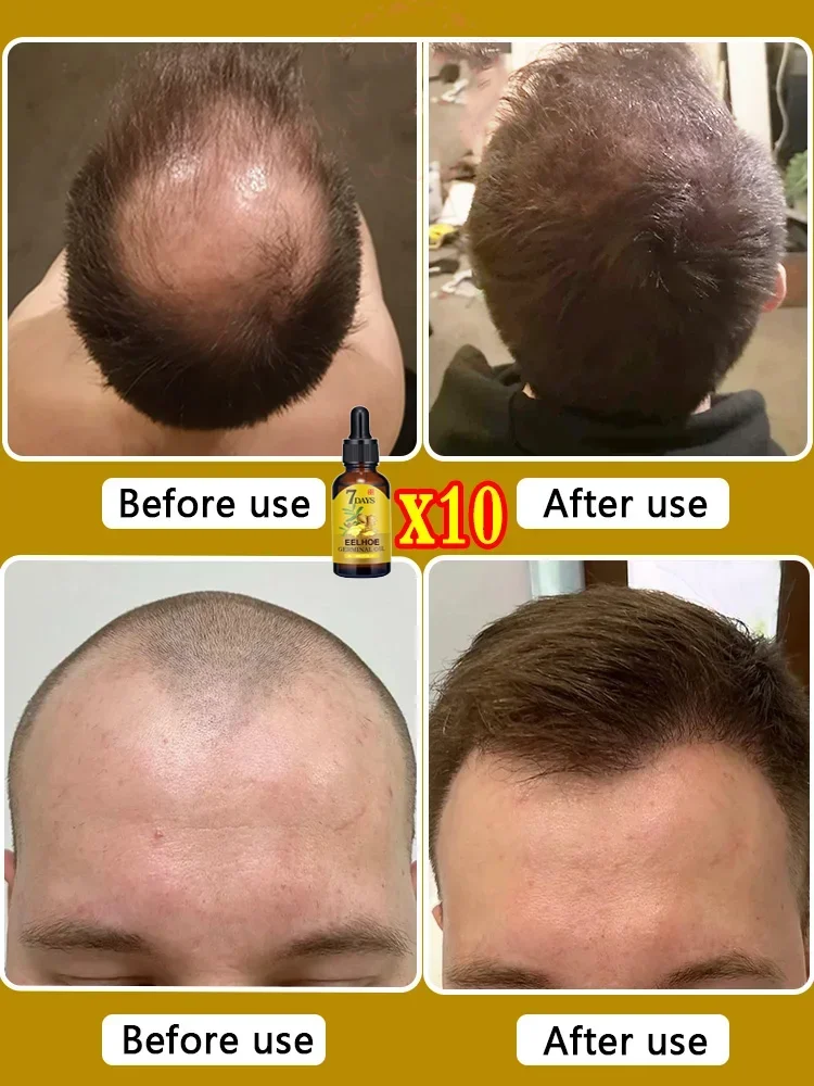 Anti Hair Loss Spray 10ml for Hair Growth