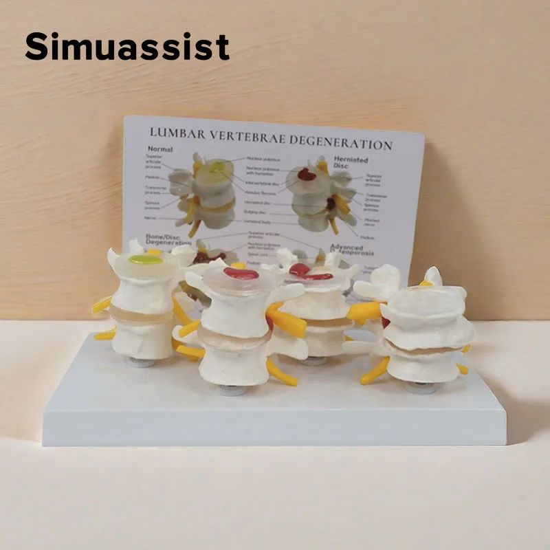 4-stage Pathological Human Lumbar Spine Anatomy Model Medical Science Teaching Resources 1
