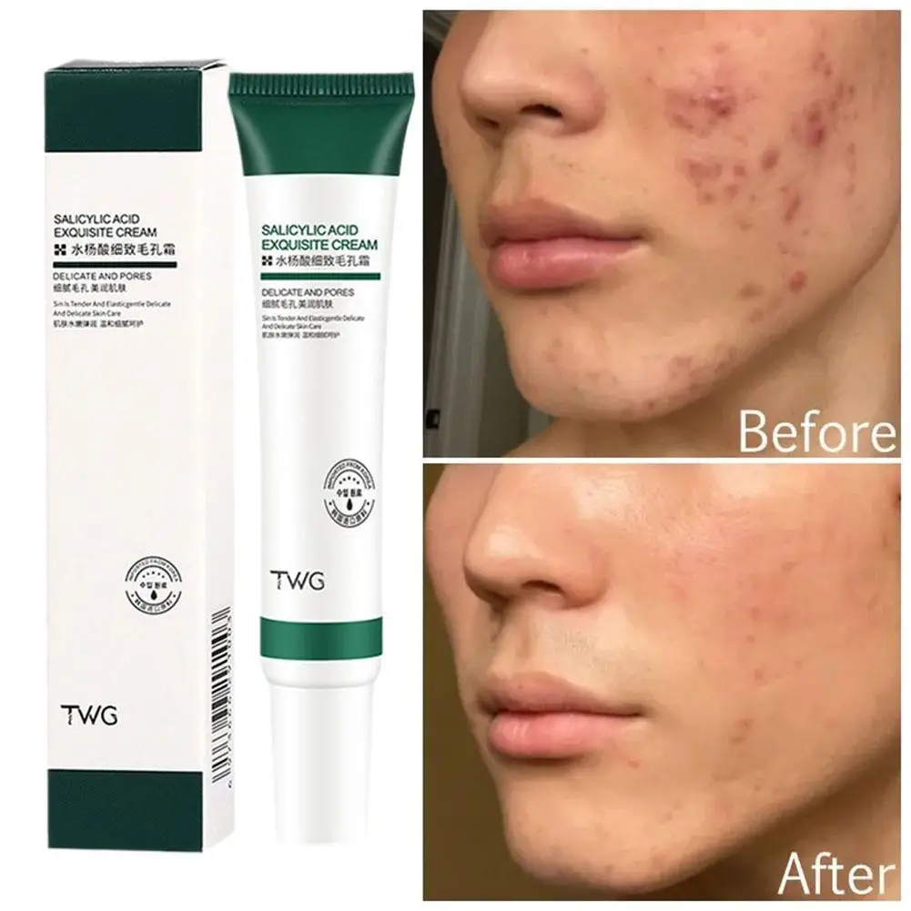 

Salicylic Acid Acne Face Cream Whitening Refining Cream Blackhead Remover Anti-aging Oil Skin Care Korean Products