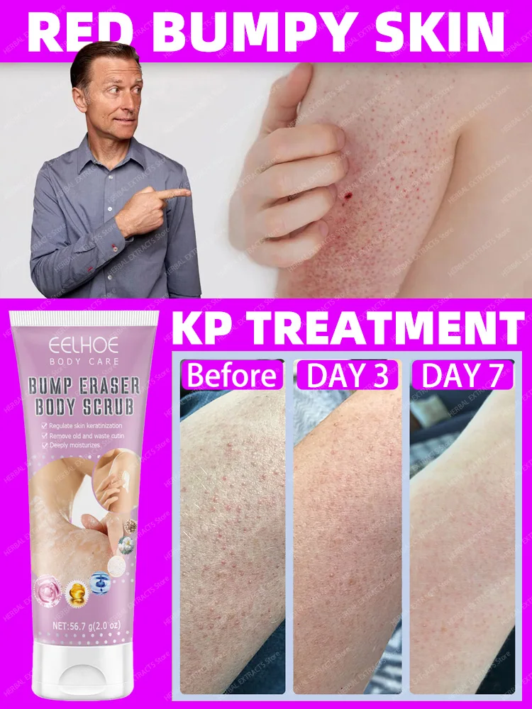 Crème de kératose Piladditif jetable, chair de poule rugueuse, petites  bosses rouges, élimination de la peau