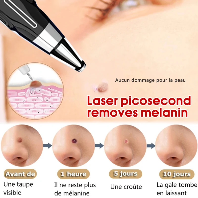 Creion laser cu picosecunde, îndepărtarea acneei, nevus, pete negre, pigment pentru tatuaje, hine_voghion.com