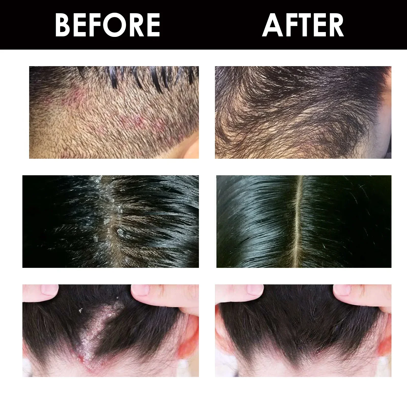 Seborrheic Dermatitis Cream Scalp Care Treatments Repair Scalp Relieve Itching Remove Dandruff Healthy Skin Hair Growth 18ml
