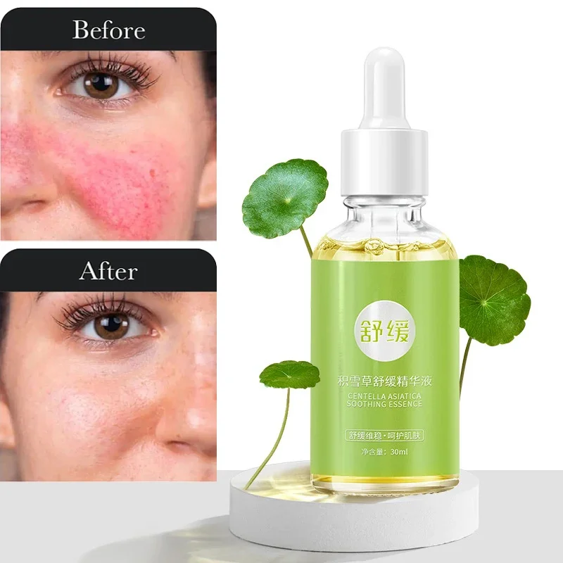 7 Day Repair Redness Serum Sooth Itching Sensitive Skin Improve Rosacea Shrink Pore Smooth Nourish Facial Skin Korean Cosmetics 6