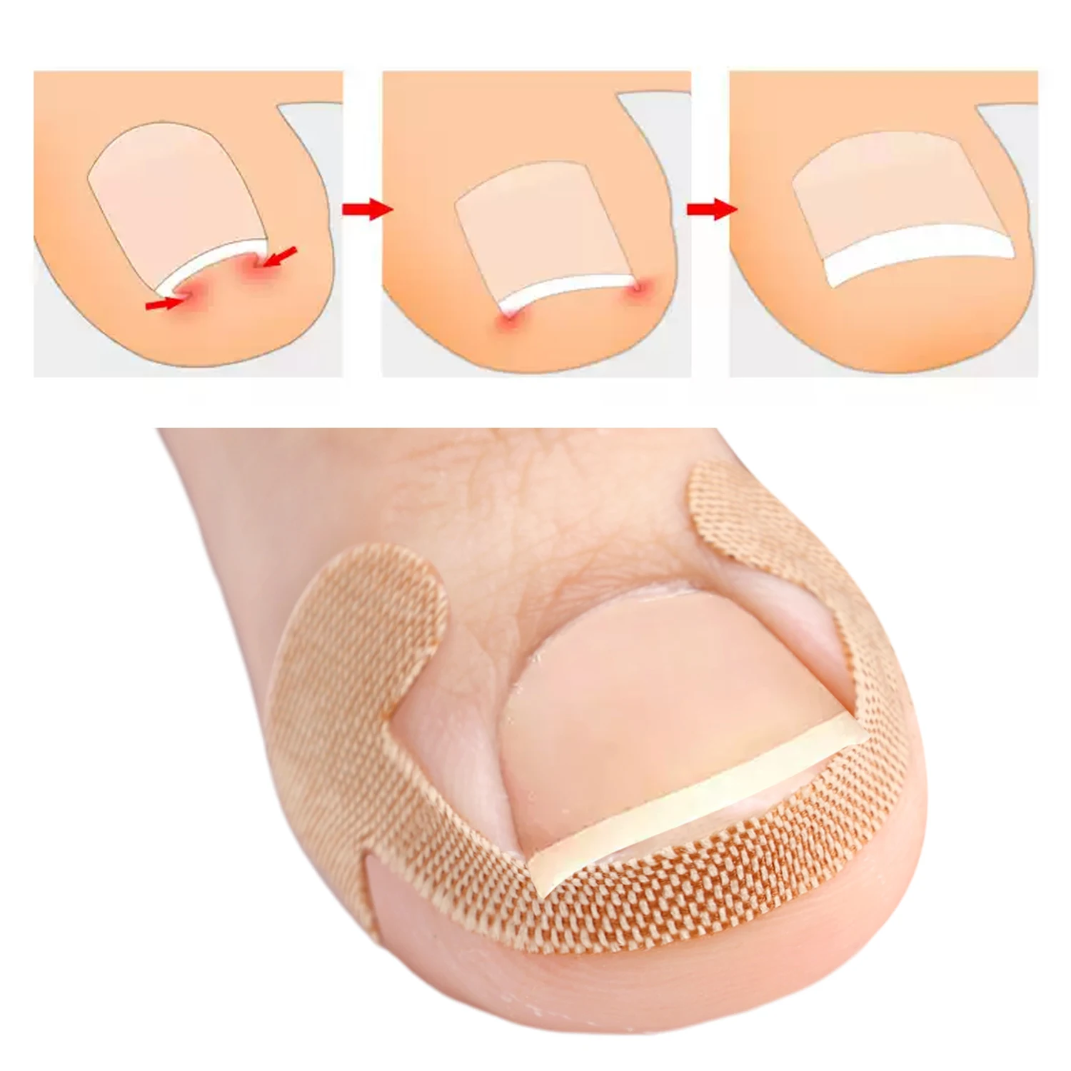 Ingrown Toenail Correction Strips Lasting Adhesion Waterproof Nail Correction Stickers Elasticity Toe Care Pedicure Tools 100pcs
