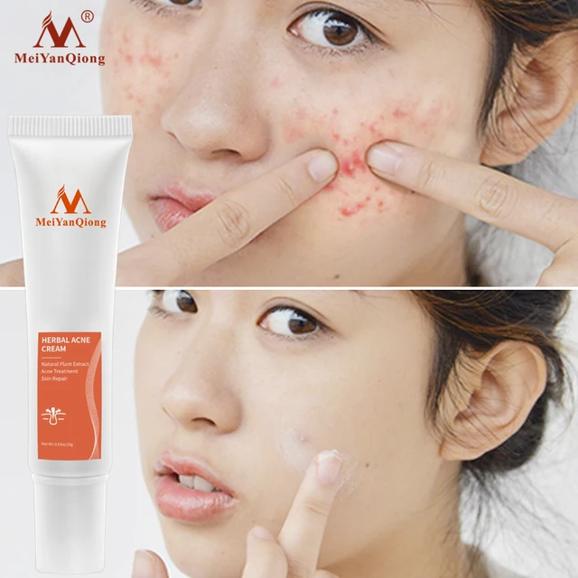 Acne Cream: O Segredo para uma Pele Livre de Imperfeições