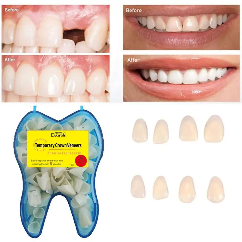 

Temporary Tooth Resin Anterior Replacement Crowns For Front Teeth Anterior Crown Temporary Tooth DIY Replace A Missing Tooth
