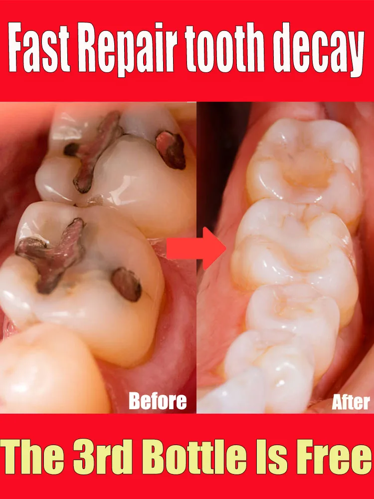 Tooth decay repair Repair all tooth decay, cavities