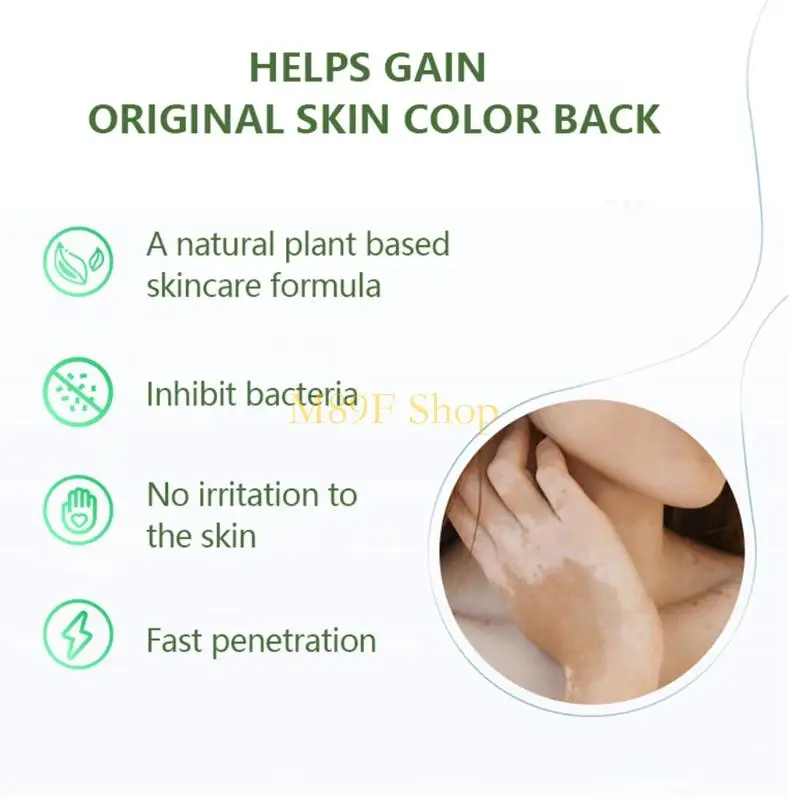 M89F 20g White Spot Localized VitiligoTreament Cream Cream Ointment Mycosis Leukoplakia