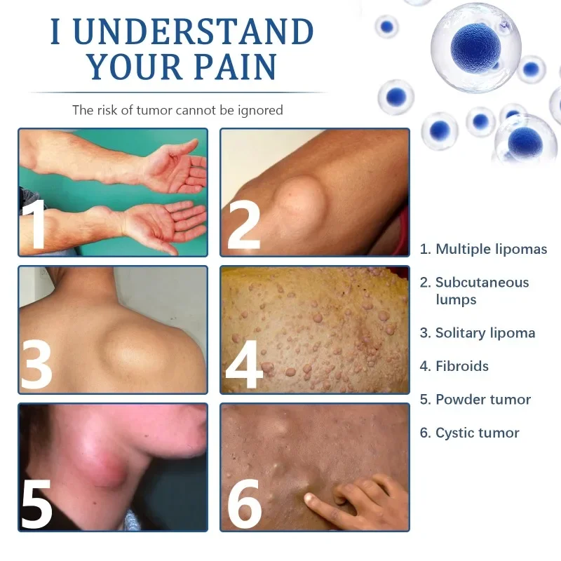 Lipoma Removal Patch Remove Fat Lump Nodular Sticker Anti-Tumor Cellulite Treat Skin Cyst Swelling Pain Relief Medical Plaster
