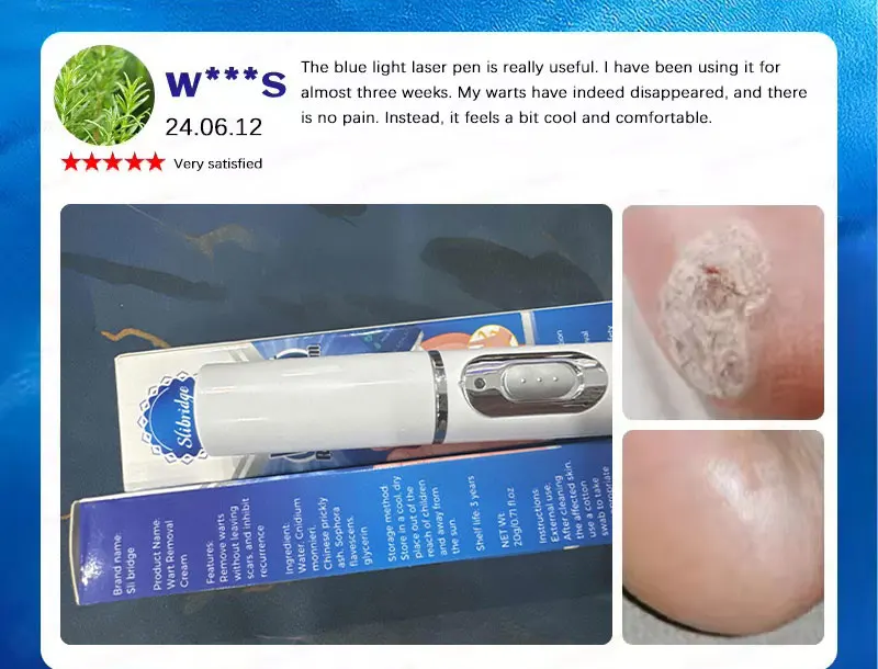 Penna a luce blu a massima potenza per la rimozione di verruche comuni e plantari, strumento per la cura delle verruche._voghion.com