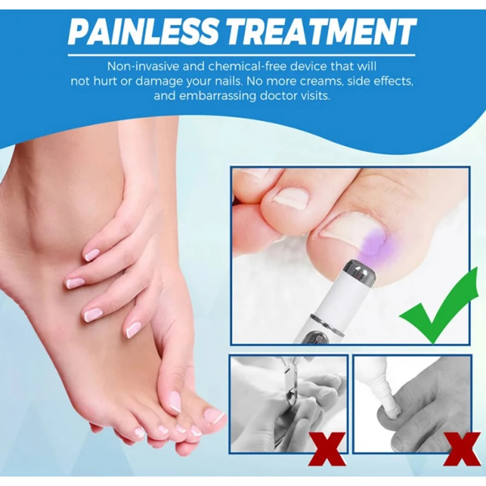 Traitement universel des mycoses des pieds et des ongles par stylo laser : élimination des mycoses des ongles, onychomycose, panaris et soins réparateurs._voghion.com