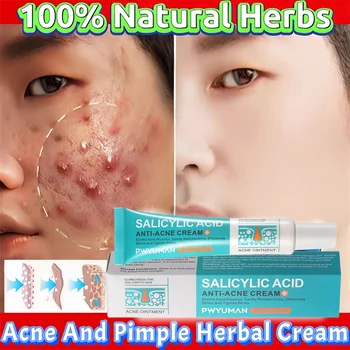 Herbal Acne Removal Cream 1