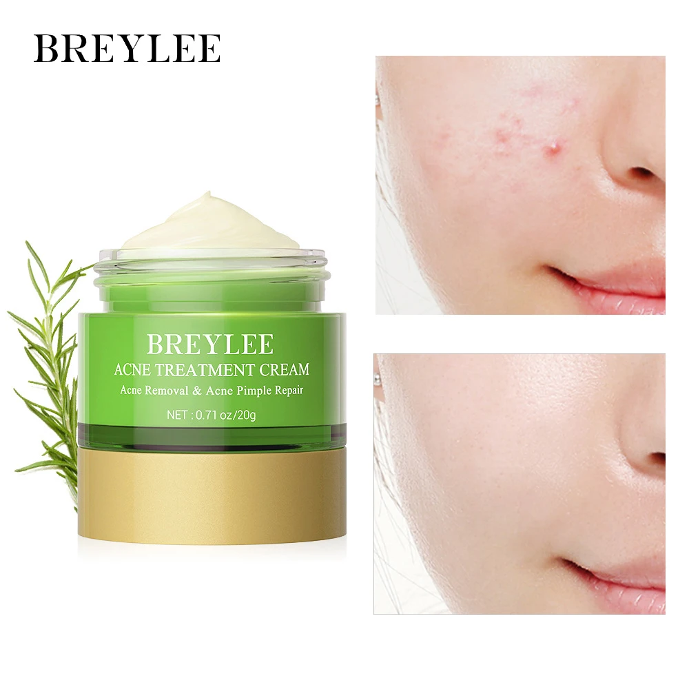 

BREYLEE Acne Treatment Cream Pimple Dirt Removal Oil Control Smooth Skin Moisturizing Shrink Pores Deep Cleansing Skin Care 20g