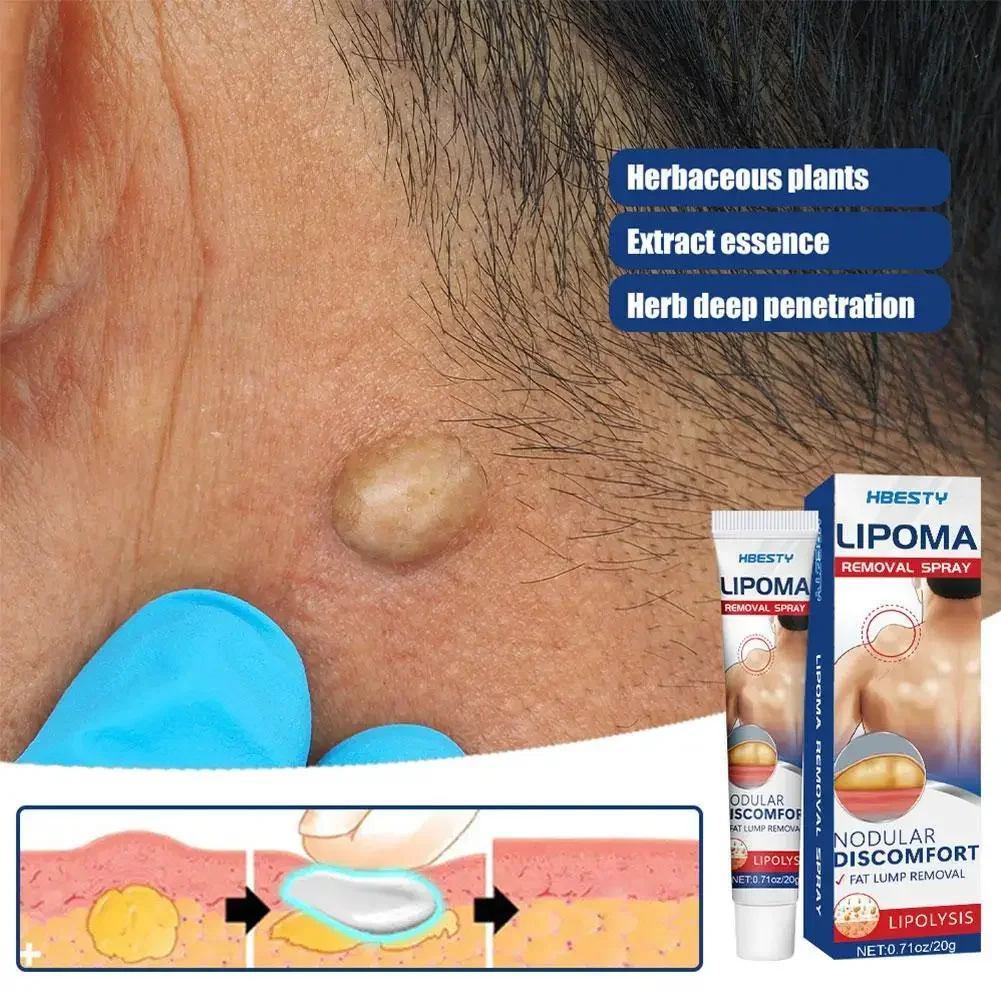Lipoma Removal Cream Effective Antitumor Remove Fat Lump Ointment Herbal Extracts Nodular Skin Cyst Swelling Painless Treatment pain relief cream,skin care ointment,knee pain relief cream,hemorrhoids treatment cream,antibacterial anti fungal cream,sex delay cream